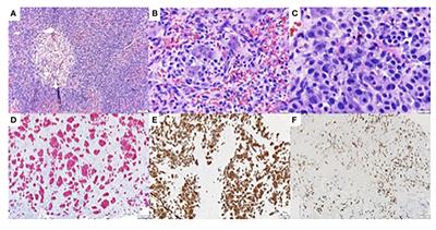 Case report: Salivary duct carcinoma in a patient with a germline CDH1 pathogenic variant - expanding the spectrum of hereditary cancer predisposition syndromes